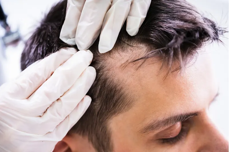 Men hair loss consultation with Dr. Carlos De La Hoz for PRP